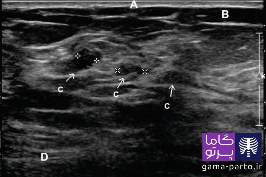 سونوگرافی سرطان پستان - گاما پرتو