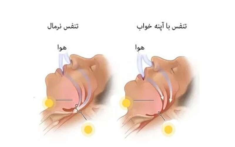 چرا صبح‌ها با سردرد از خواب بیدار می‌شویم؟
